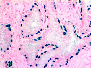 p63 Antibody Immunohistochemistry on an FFPE Prostate Tissue